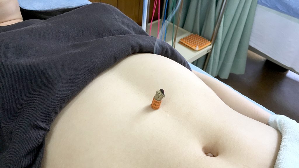 よだれつわりと鍼灸治療