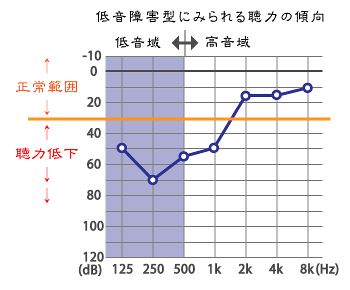 低音障害型感音難聴