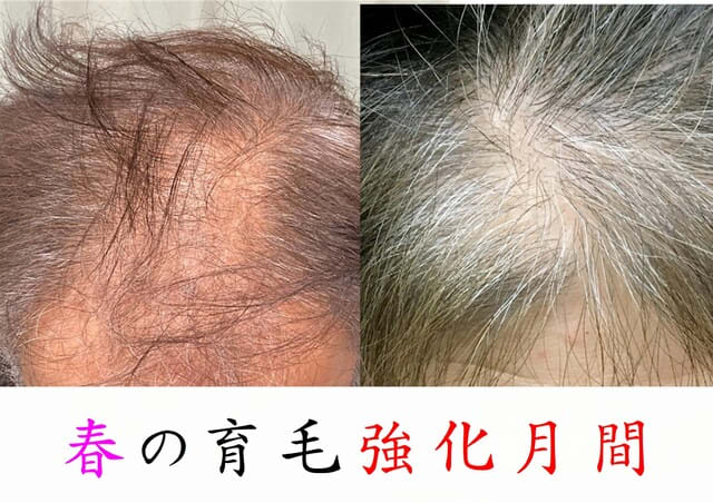 春から夏の育毛強化月間