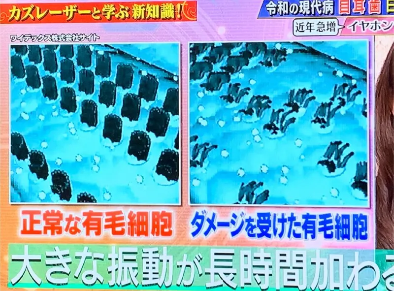 難聴と有毛細胞の関係