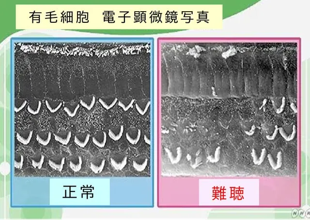 有毛細胞が壊れる加齢性難聴