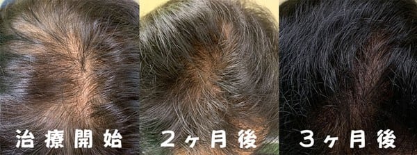 薄毛、抜け毛治療