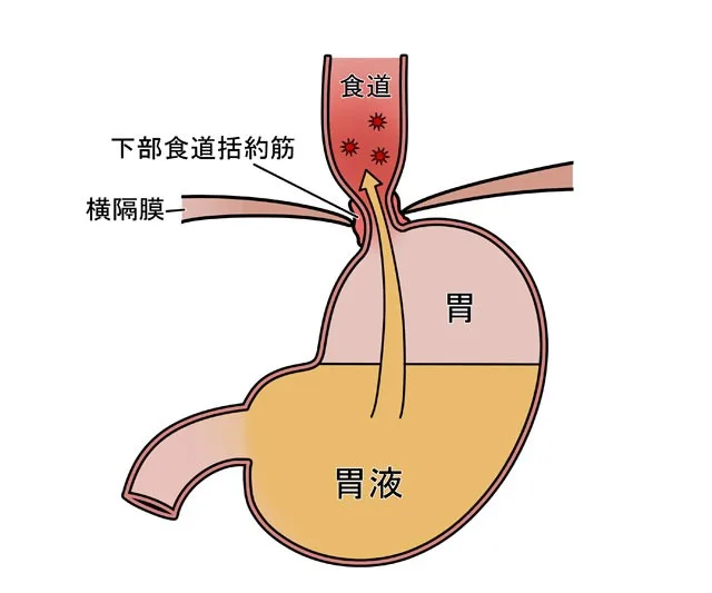 逆流性食道炎